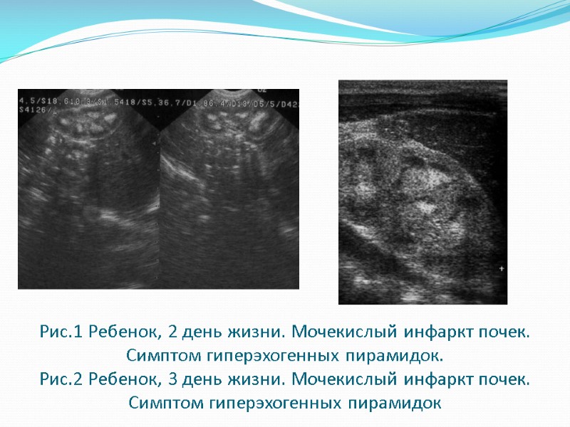 Рис.1 Ребенок, 2 день жизни. Мочекислый инфаркт почек. Симптом гиперэхогенных пирамидок. Рис.2 Ребенок, 3